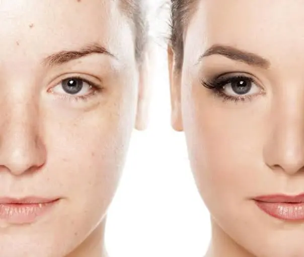 before-after