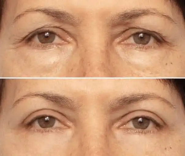 before-after