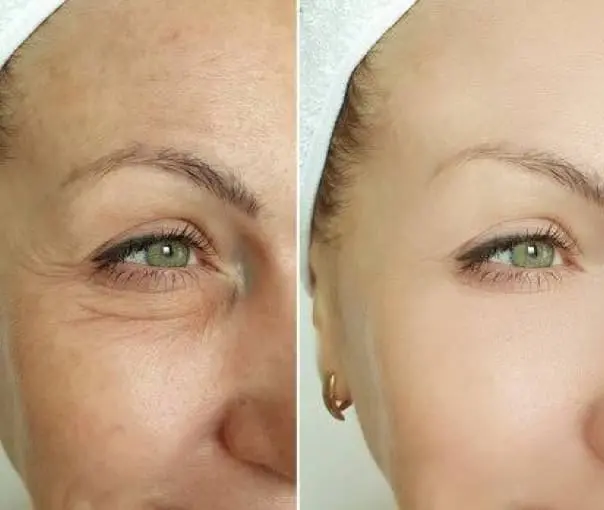before-after