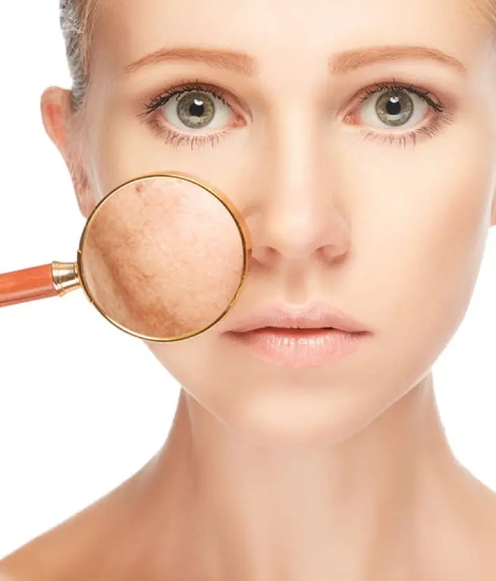 Common Types of Pigmentation