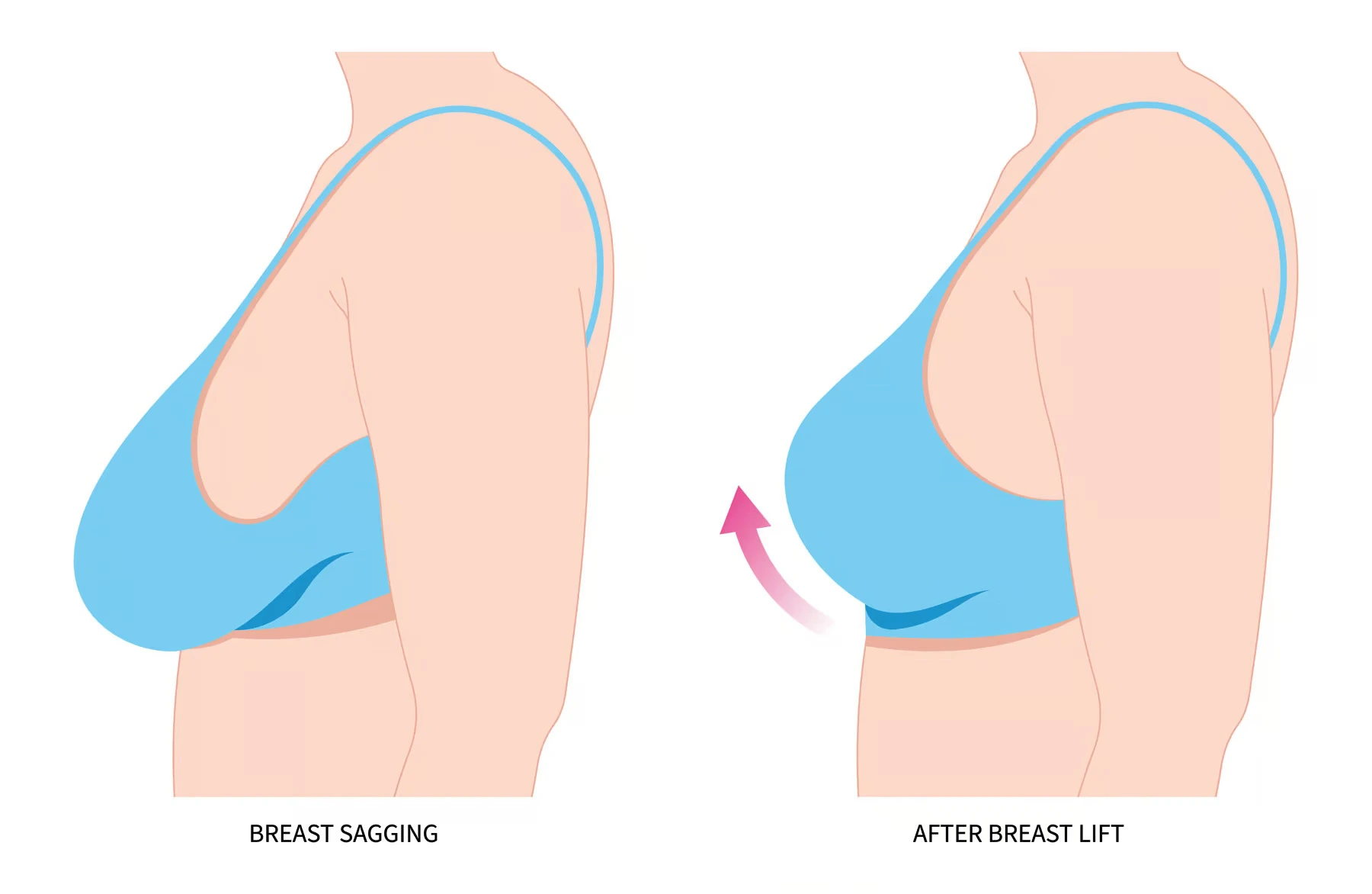Rediscover Confidence with Breast Lift Surgery