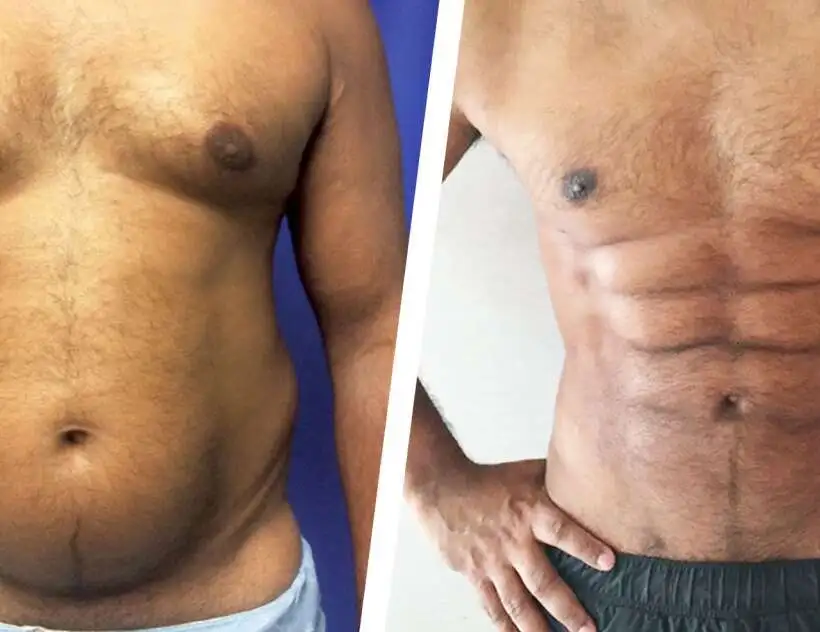 Understanding the Procedure