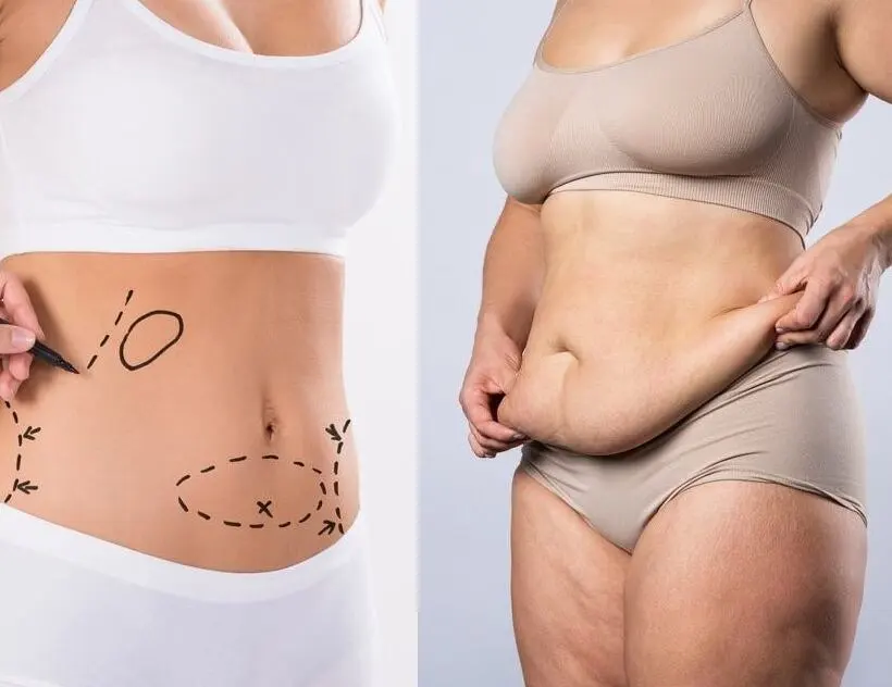 Who is a candidate for liposuction surgery ?