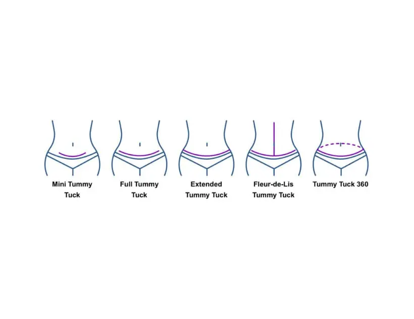 Types of Tummy Tuck