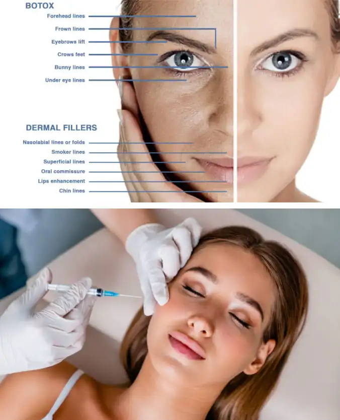 Benefits of Botox Injections