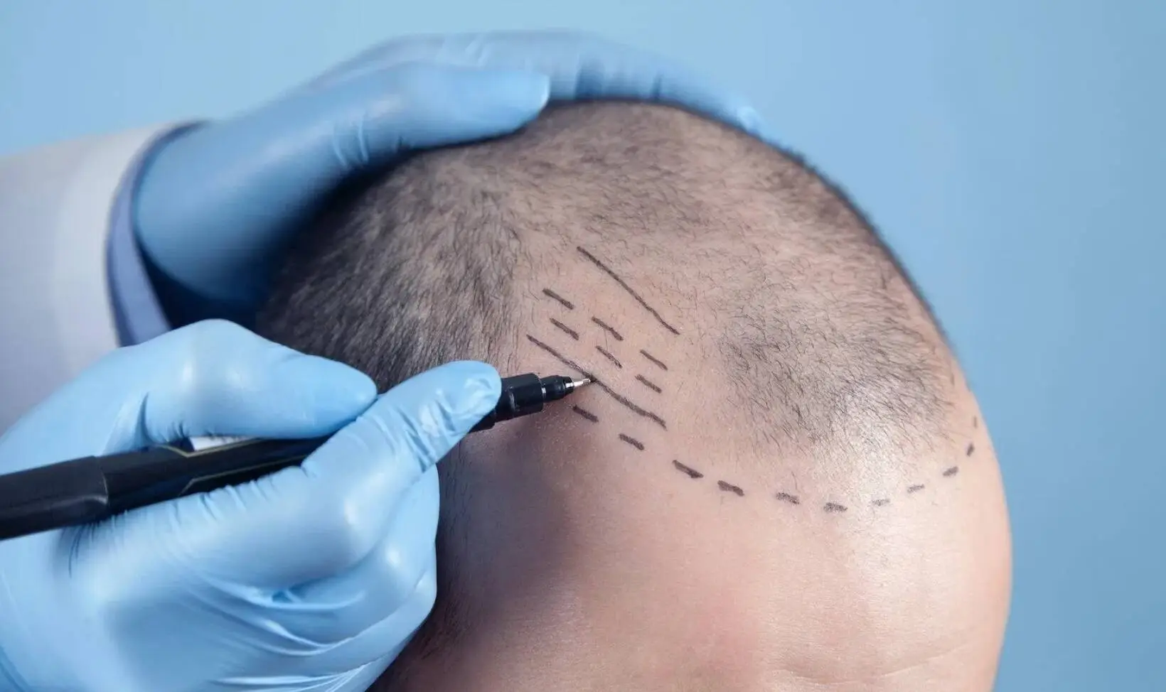 Who Are the Candidates for Hair Transplant ?