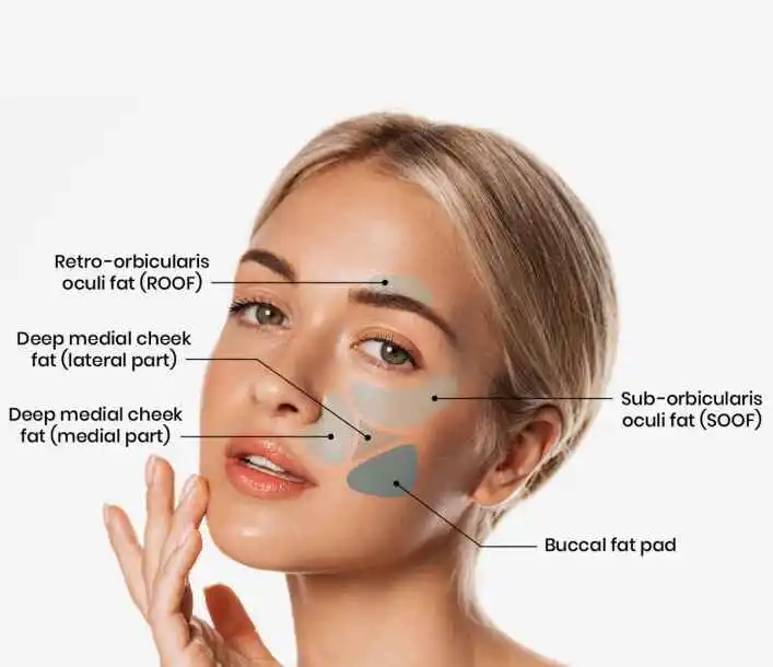 What is Buccal Fat Removal?