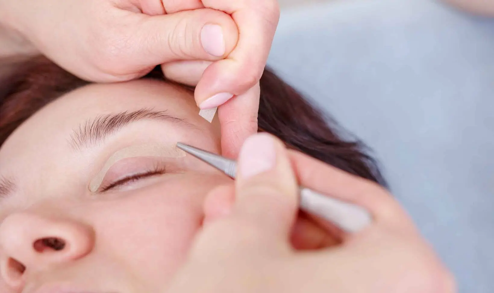 What is upper eyelid surgery?