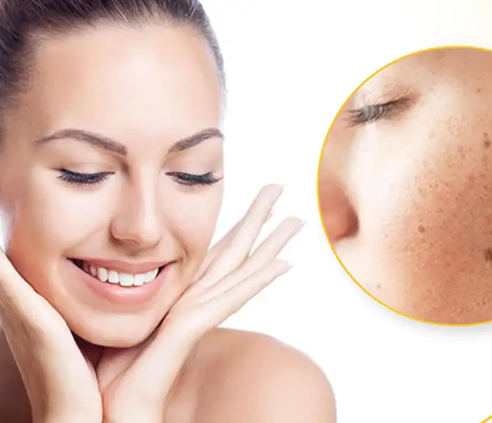 Pigmentation Treatment at Phoenix Cosmetic Centre