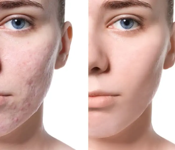 Acne Scar Treatment at Phoenix Cosmetic Centre