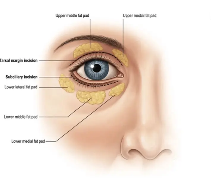 Blepharoplasty at Phoenix Cosmetic Centre