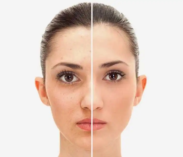 Face Lift (Rhytidectomy) Surgery