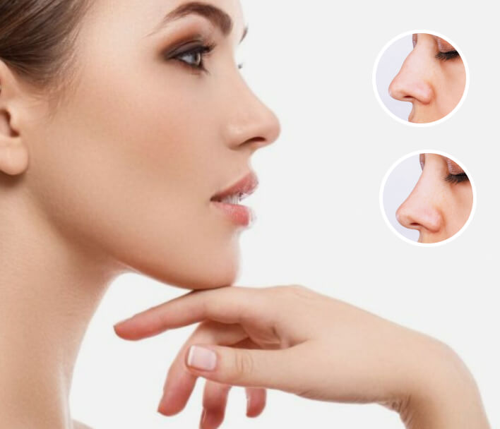 Rhinoplasty at Phoenix Cosmetic Centre