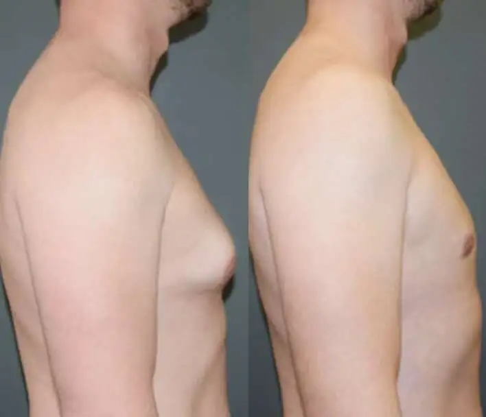 Regain Confidence with Gynecomastia Surgery