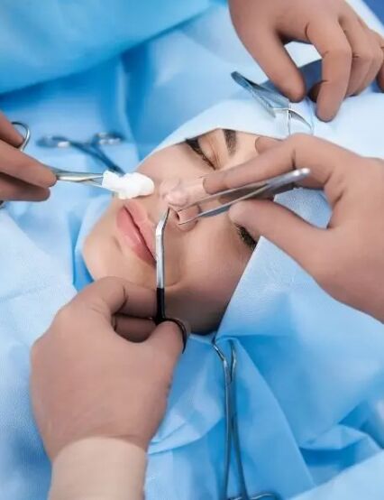 Rhinoplasty